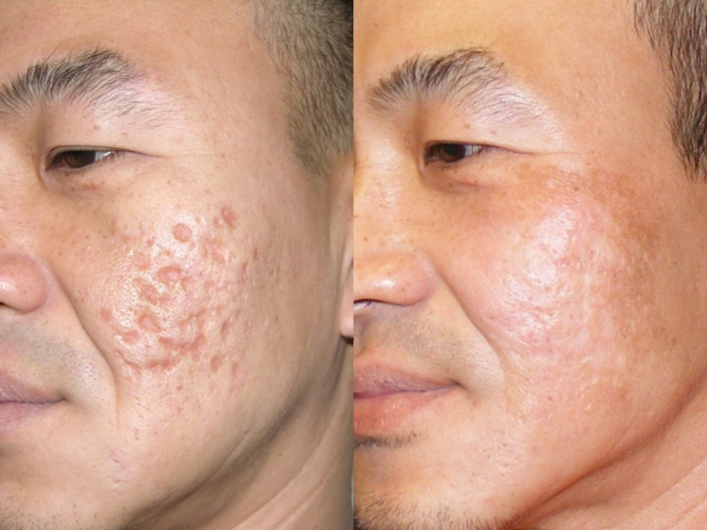 Dermapen Microneedling Cayman Doctors